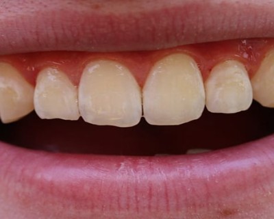 How to get rid of white spots on teeth from whitening strips