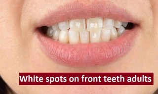 White spots on front teeth adults