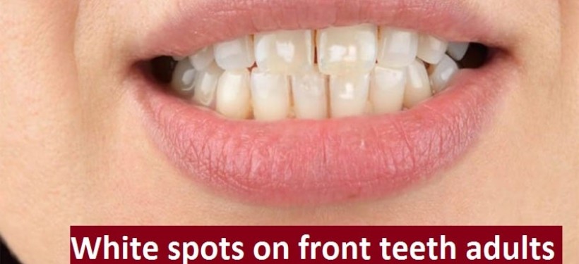 White spots on front teeth adults